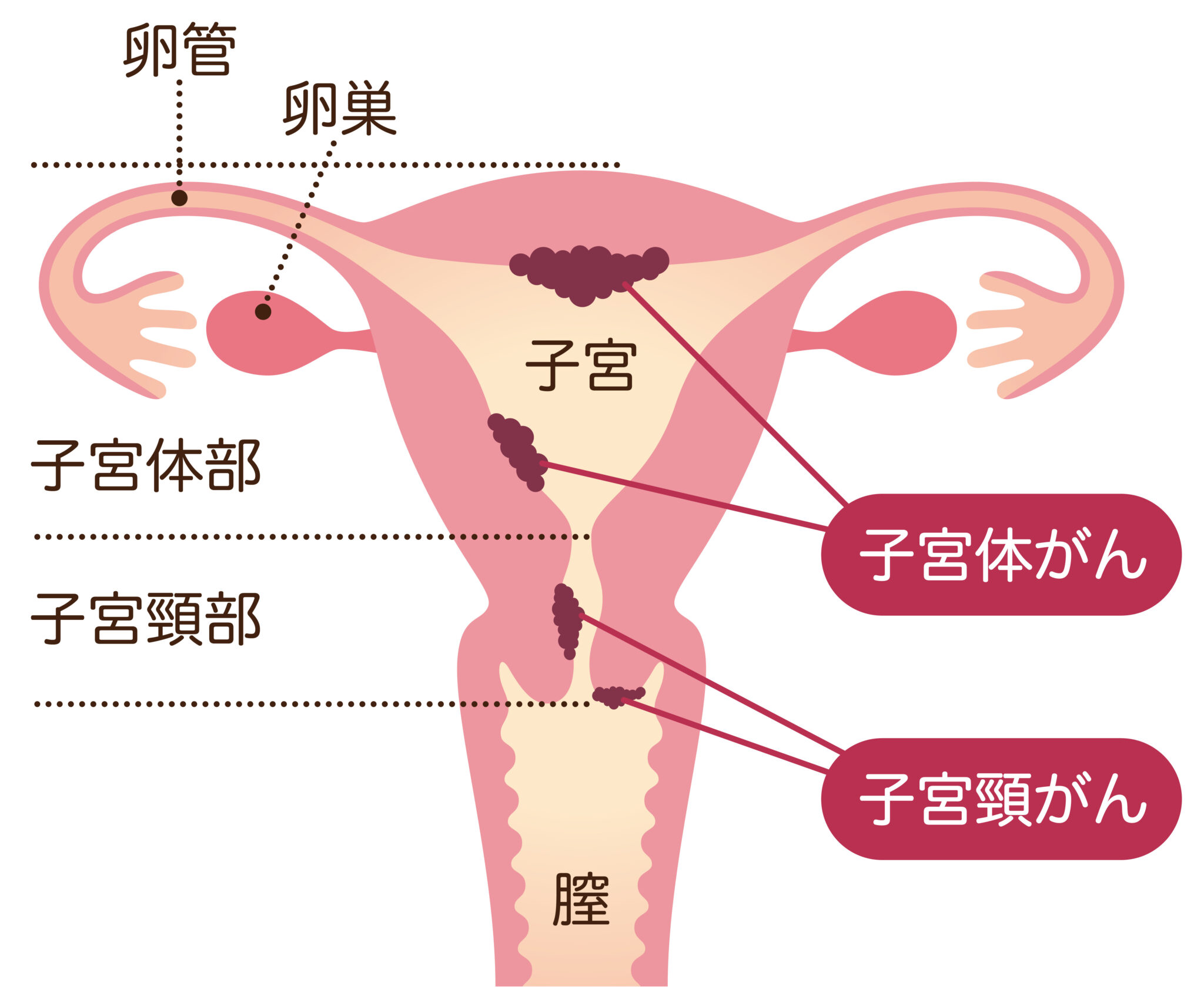 子宮がん検診｜文京ガーデン女性クリニック 後楽園 春日の産科・婦人科